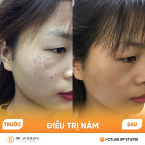 dieu-tri-nam-01