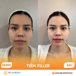 tiem-filler