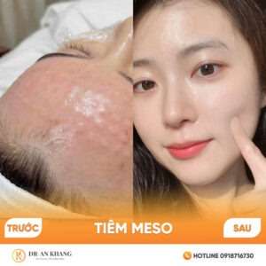 tiem-meso-02