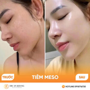tiem-meso