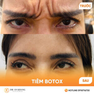 tim-botox-01