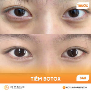 tim-botox-02