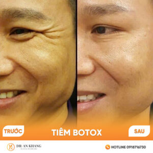 tim-botox-03